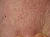Los prebiticos protegeran a los nios del eczema cutneo