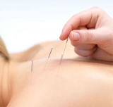 La acupuntura esttica se suma a los tratamientos antiage