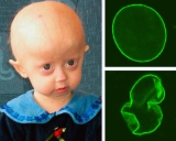 Progeria: sorprendente hallazgo cientfico podra ser clave para frenar el paso del tiempo