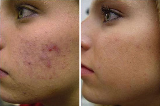 Isotretinoína: un tratamiento muy efectivo y seguro para el acné