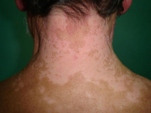 La muerte de los melanocitos: el vitiligo