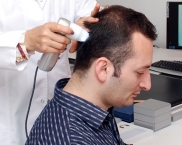 5 opciones para tratar la alopecia: mesoterapia, alta frecuencia, ultrasonido, PRP y terapias tópicas